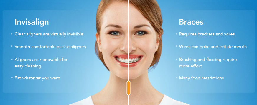 invisalign benefits